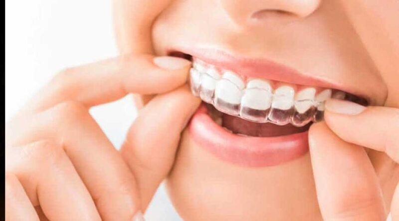 The-Role-of-Retainers-After-Invisalign-Treatment