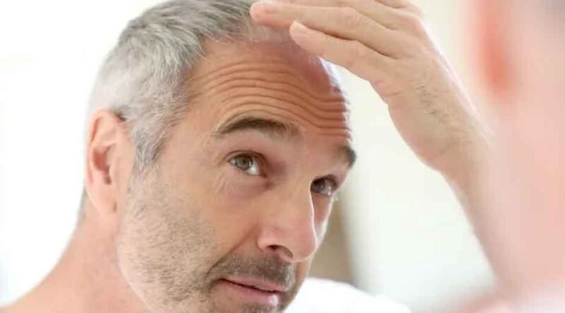 What-Surprising-Options-Are-Tampa-Bay-Residents-Using-to-Tackle-Hair-Loss