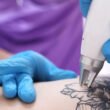 What to Expect From Tattoo Removal in 2026