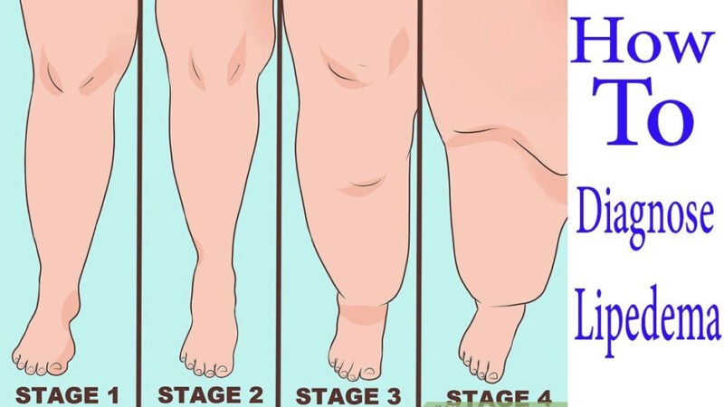 Why Is Early Diagnosis Key to Successful Lipedema Management?